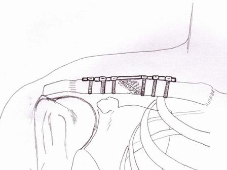 Clavicle Fractures