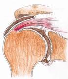 Arthroscopic Acromioplasty