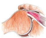 Shoulder - Arthroscopic Acromioplasty