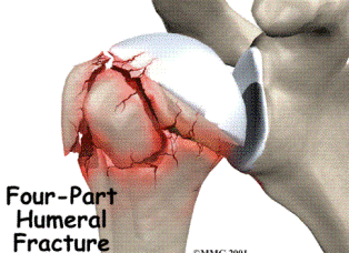 Proximal Humeral Fractures