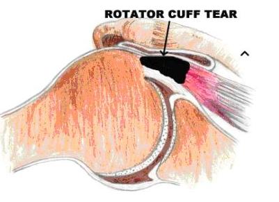 Shoulder - Arthroscopic Rotator Cuff Repair