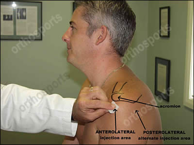 Steroid injection into subacromial space