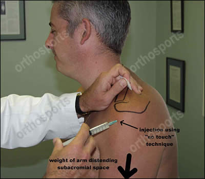 Shoulder anabolic steroid injection technique