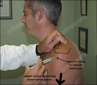 Steroid injection into shoulder bursa