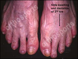 Mechanical 2nd MTP Synovitis