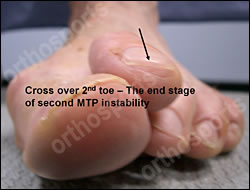 Foot - Mechanical 2nd MTP Synovitis