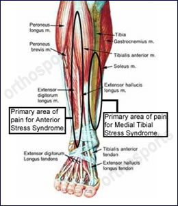 Exercise Related Shin Pain