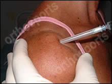 Injection site pain steroids